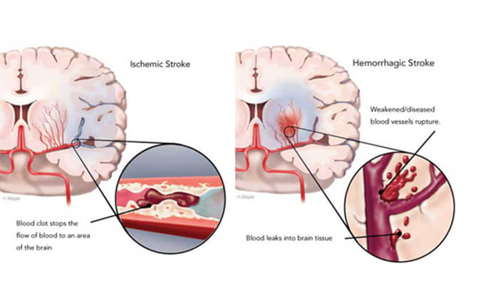 天下卒中日：从动物药效模子评价看心脑血管药物开发